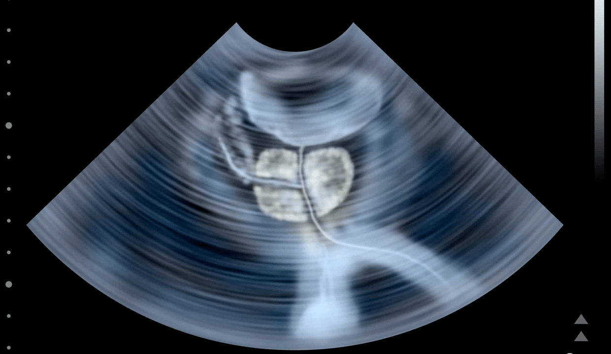 Ultrasound examination of prostatitis asphyxiation